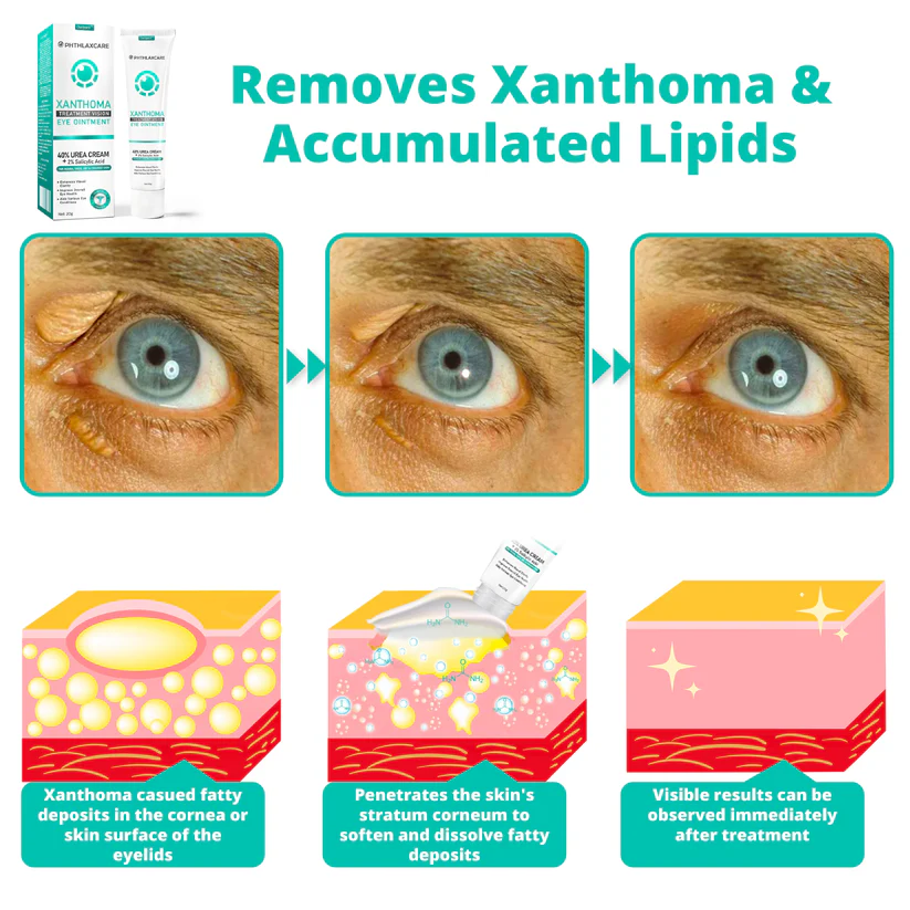 Ourlyard™ OphthlaXcare Xanthoma Treatment Vision Enhance Eye Ointment - Image 5