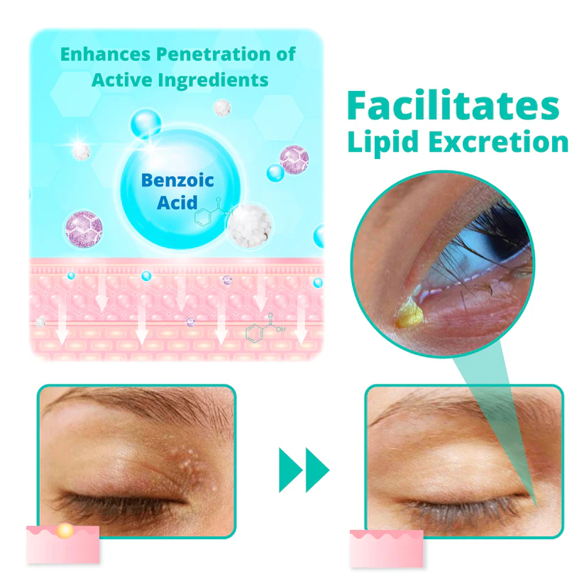 Ourlyard™ OphthlaXcare Xanthoma Treatment Vision Enhance Eye Ointment - Image 4