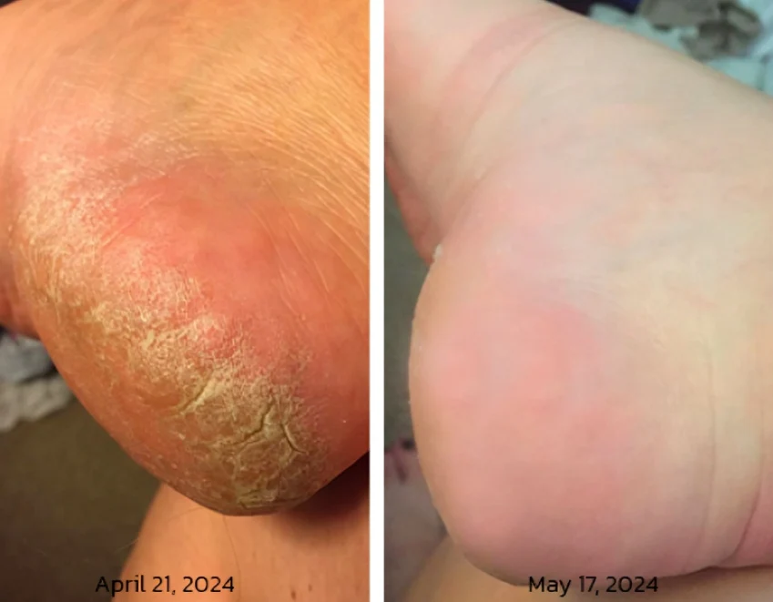 GFOUK™ PediSpa Foot Scrub Spray - Image 3