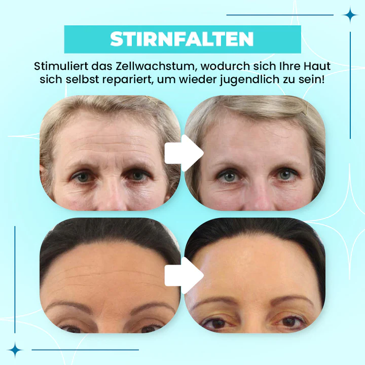 Anti-wrinkle Forehead Line Removal Gel Patch - Image 9