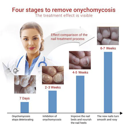 NailREBORN™ Antifungal - Professional Strength - Image 2