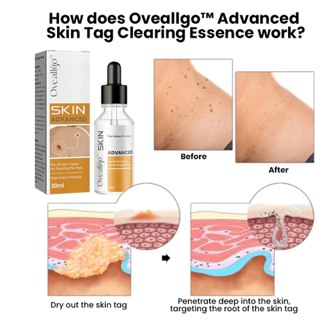 Oveallgo™ Advanced Skin Tag Clearing Essence - Image 7