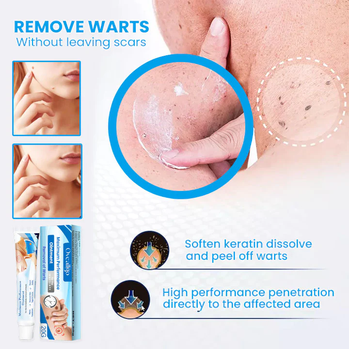 Oveallgo™ Maximum Performance Ointment for the Immediate removal of Warts - Image 5