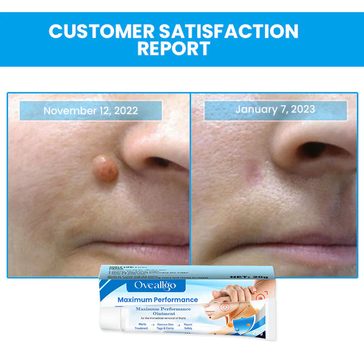 Oveallgo™ Maximum Performance Ointment for the Immediate removal of Warts - Image 8