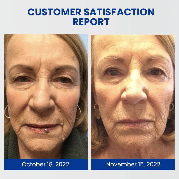 Oveallgo™ WartsOff Instant Blemish Removal Cream - Image 8