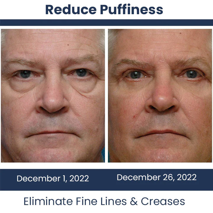 Oveallgo™ PEULINSEU NMN9900+ Awaken Peptide Depuffing Eye Gel - Image 7