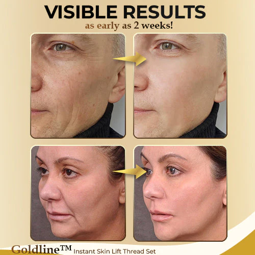 Goldline™ Instant Skin Lift Thread Set - Image 5