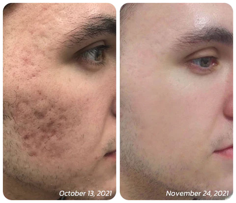 flysmus™ BoLiftox PockmarksTreat Collagen Astaxanthin Roller - Image 3