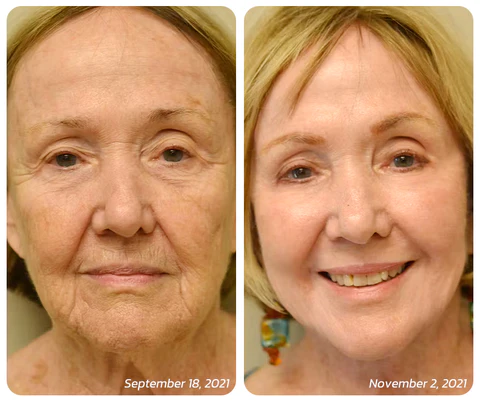 flysmus™ BotoxLUX Collagen Anti Aging Serum - Image 7