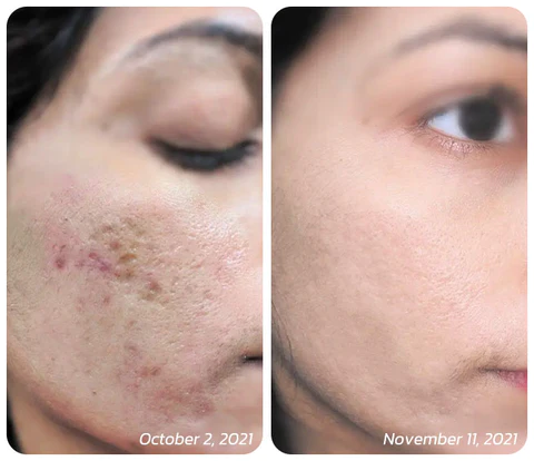 flysmus™ BoLiftox PockmarksTreat Collagen Astaxanthin Roller - Image 2