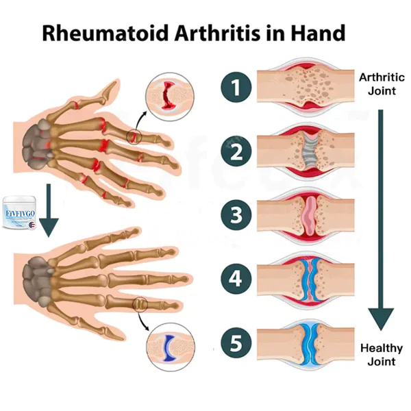 Oveallgo™ Joint & Bone Therapy Cream - Image 5