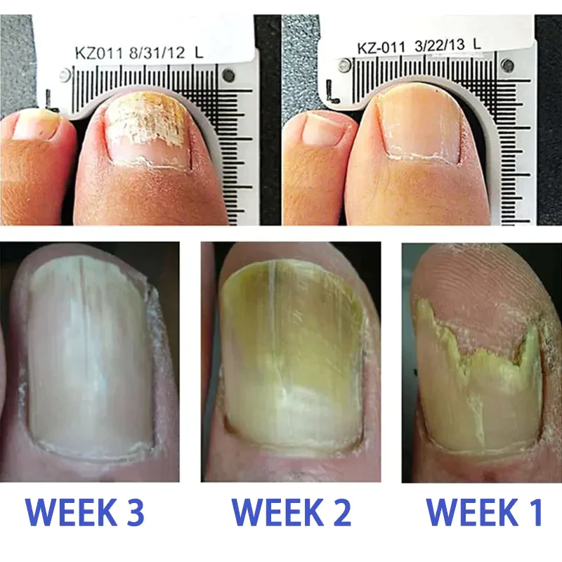 FootFree™ Antifungal - Professional Strength - Image 2