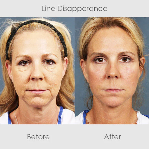 ChaffeeLife™ Wrinkle Reversing Botox Serum - Image 6