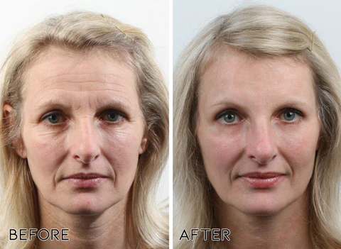 Oveallgo™ Korean Snail Collagen Lifting & Firming Mist - Image 5