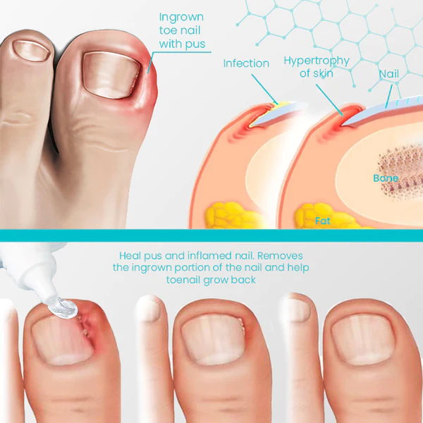 NailRevive™ Psoriasis Recovery Gel - Image 5