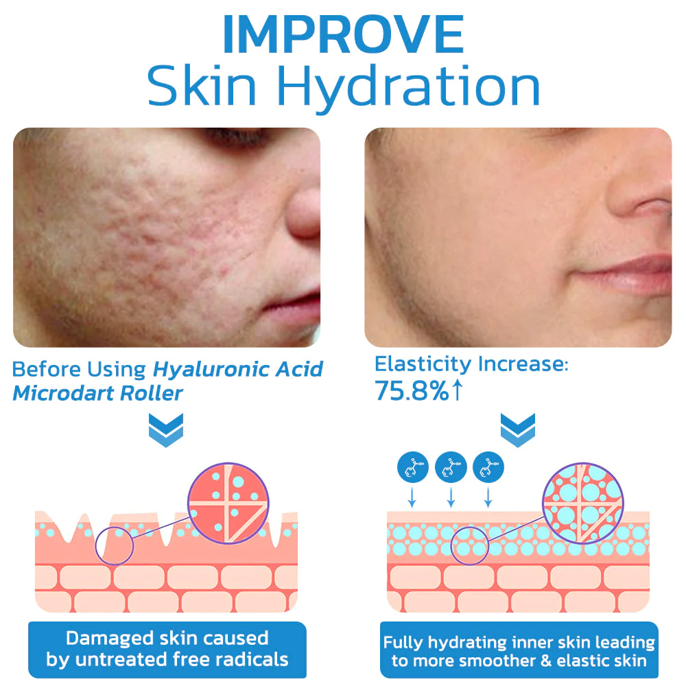 flysmus™ PockmarksHeal Hyaluronic Acid Microdart Roller - Image 5