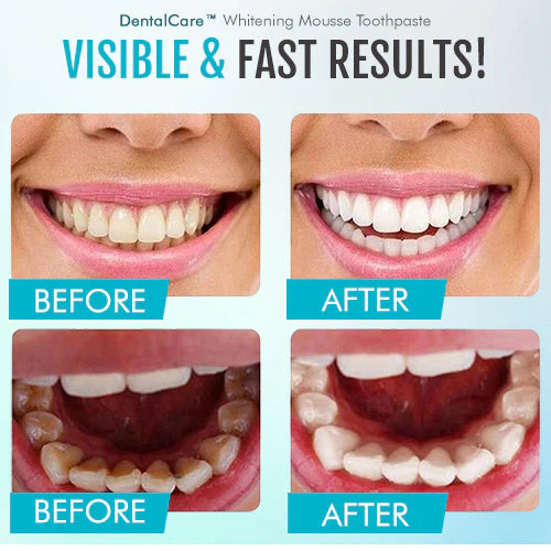 DentalCare™ Whitening Mousse Toothpaste - Image 6