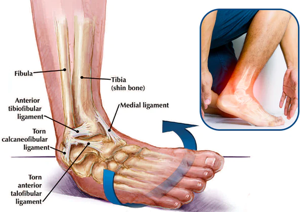 GFOUK™ German Ankle Tendonitis Therapy Oil - Image 6