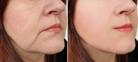 flysmus™ EMS V Shape Microcurrent Rolling Device - Image 8