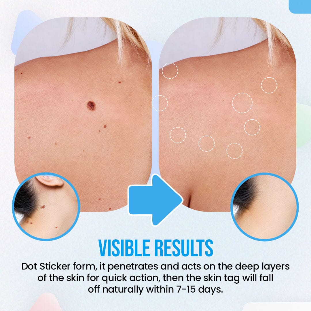 Herbal Extract Warts Clear Dot Stickers - Image 5