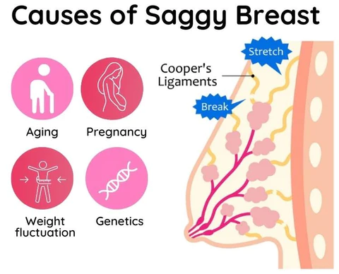 LiftElite™ Breast Enhancement Set - Image 6