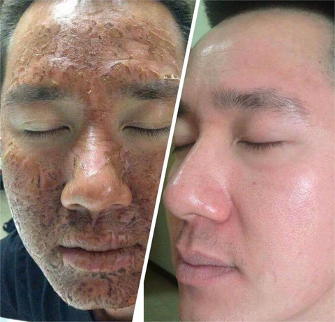 Oveallgo™ Whitening Peeling Oil for Dark Spot & Acanthosis Nigricans - Image 7