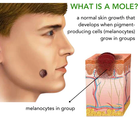 DermaClear™ Nevus Removal Cream - Image 6