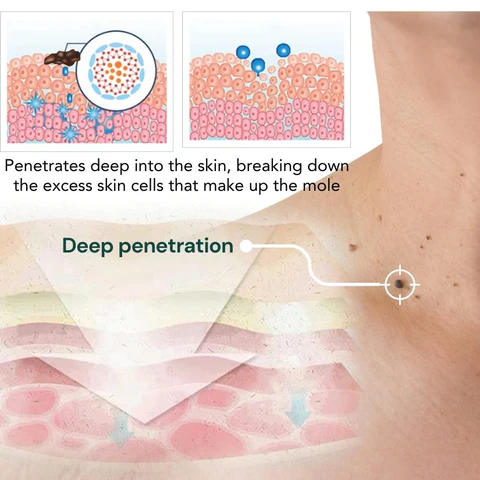DermaClear™ Nevus Removal Cream - Image 8