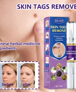 EELHOE™ Warts and Moles Herbal Removal Pen