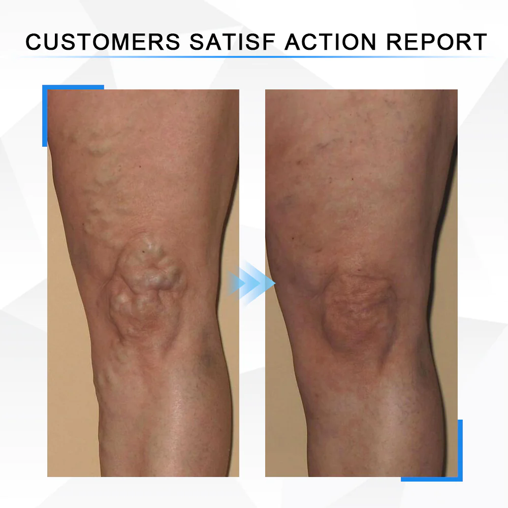 Hapygo™Fulgurite Ionic Body Shaping Stretch Knee Brace - Image 7