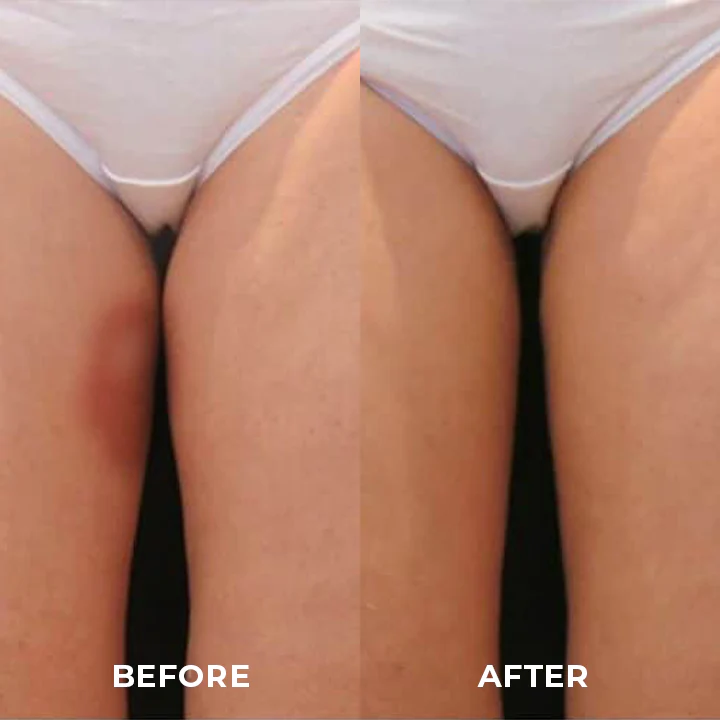 BeautyMAX™ Inner Thigh Anti Chafing Stickers - Image 7