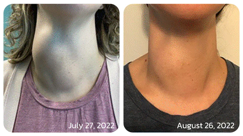 GFOUK™ ThyroidCare Anti Swelling Lymphatic Cleaning Roller - Image 8