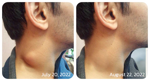 GFOUK™ ThyroidCare Anti Swelling Lymphatic Cleaning Roller - Image 7