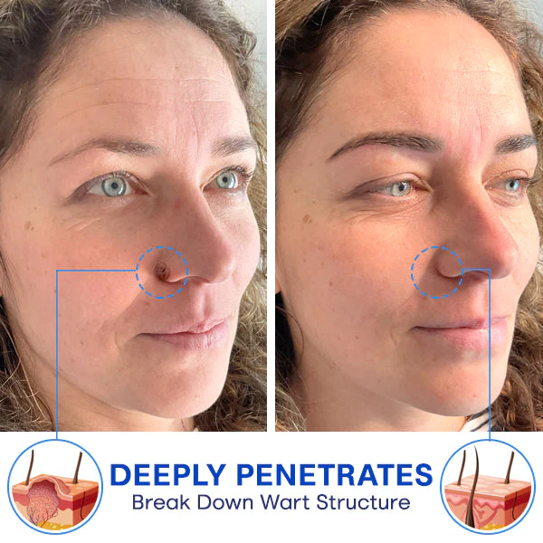 Blusoms™ FreezeZap WartGone Serum - Image 6