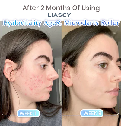 Liascy™ HyaloVitality Microdarts Roller - Image 6