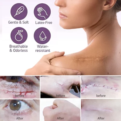 BIOCLEAR™ Silicone Scar Reduction Sheets - Buy Today Get 55% Discount -  MOLOOCO