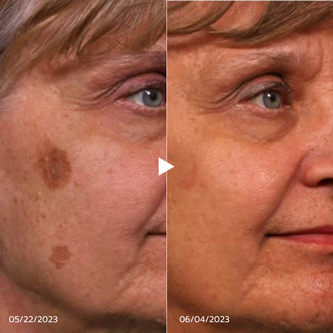 BEAUTX™ UV Phototherapy Scar Removal Pen - Image 6