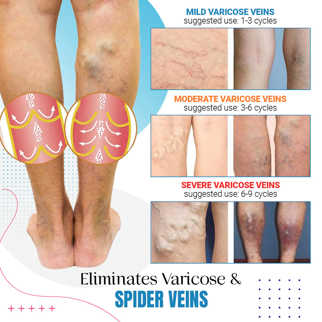 Raura™ Varicose Veins Treatment Spray - Image 5