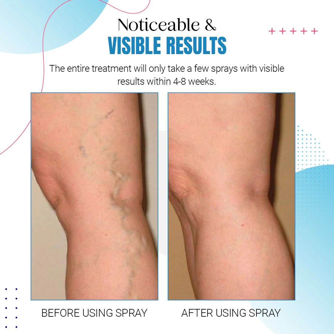 Raura™ Varicose Veins Treatment Spray - Image 9