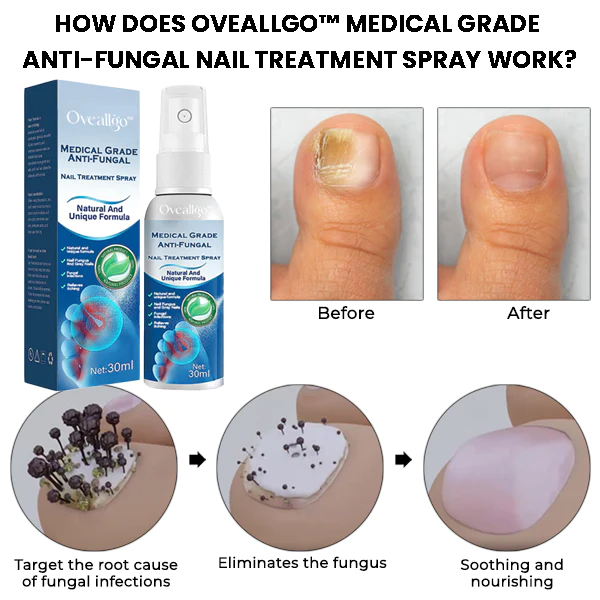 Oveallgo™ Medical Grade Anti-Fungal Nail Treatment Spray - Image 2