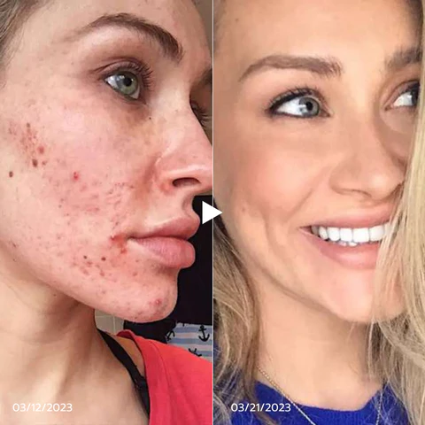 BEAUTX™ UV Phototherapy Scar Removal Pen - Image 5