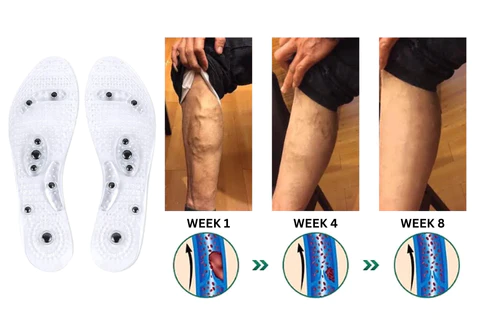 Oveallgo™ VeinCare MagAcupoint Reflexology Insole - Image 7