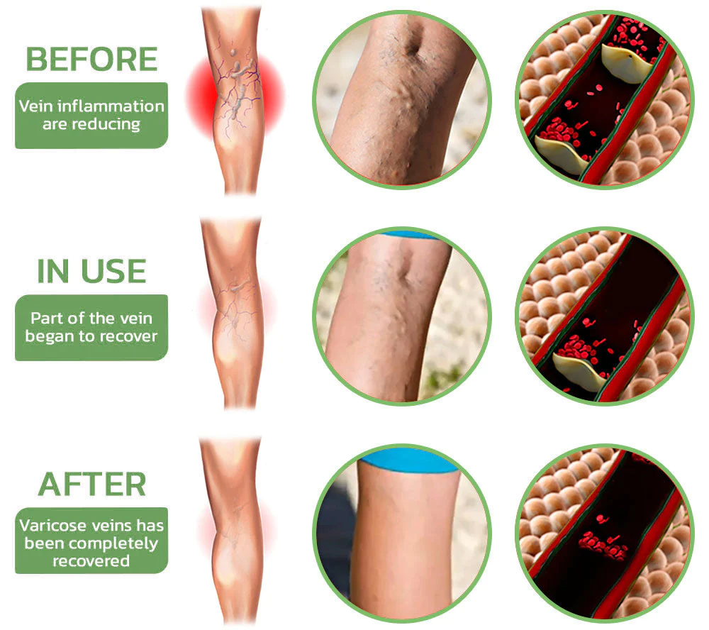 HealLegs™ Fat Burning Shaping & Varicose Veins Immediate Relief Burst Beads Patch - Image 4