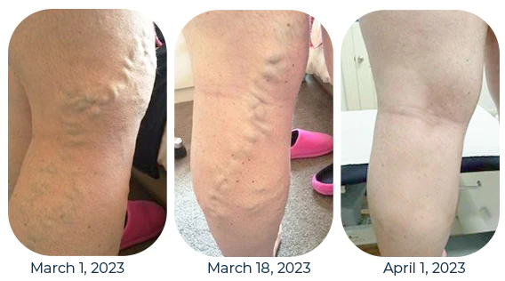 GFOUK™ Mucopolysaccharide Polysulfate Cream - Image 8