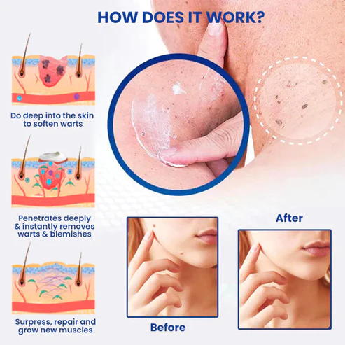 DermaEnd™ Wart Remover Herbal Ointment 100% Natural - Image 7