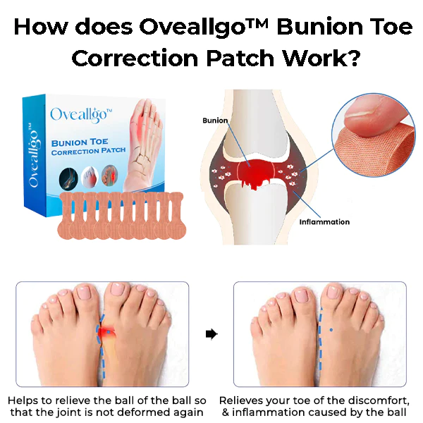 Oveallgo™ Bunion Toe Correction Patch - Image 2