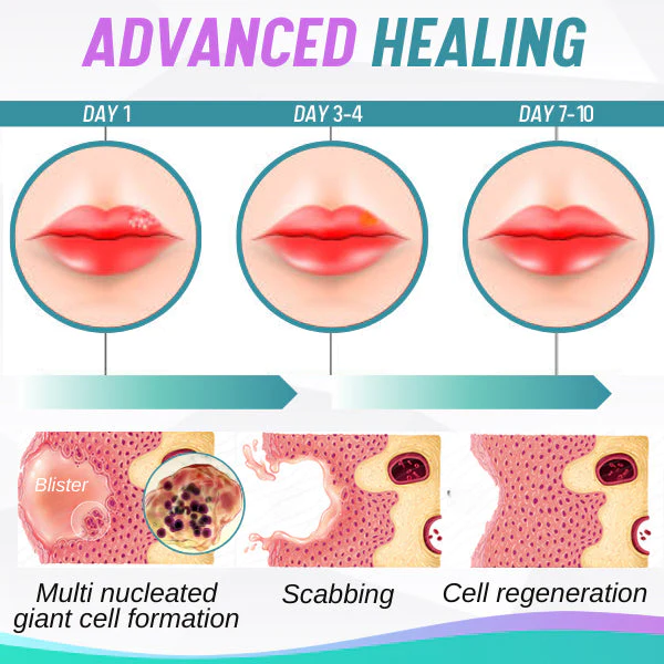Mediwise™ Herpes Cold Sore Cream - Image 4