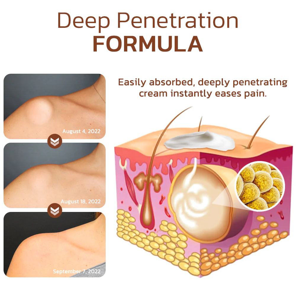 GFOUK™ Lumpless Lipoma Treatment Cream - Image 2