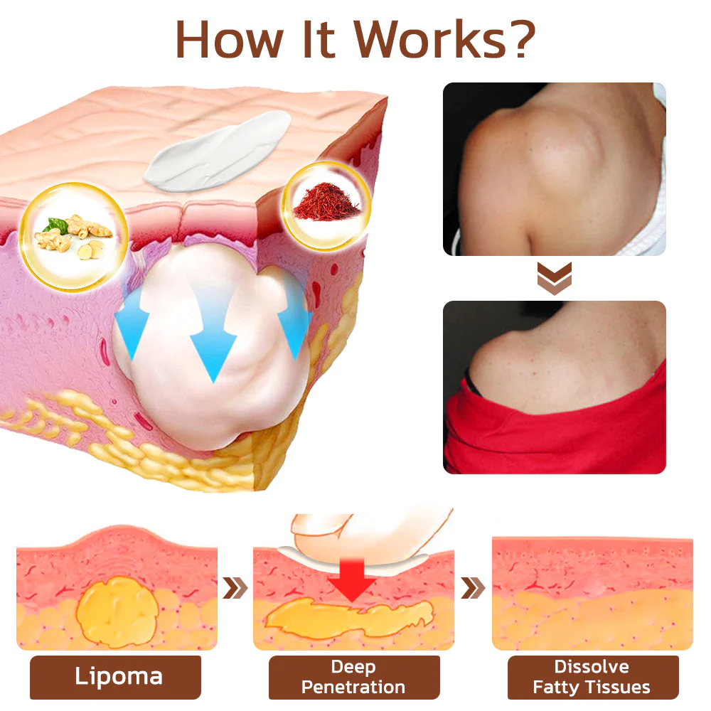 GFOUK™ Lumpless Lipoma Treatment Cream - Image 3