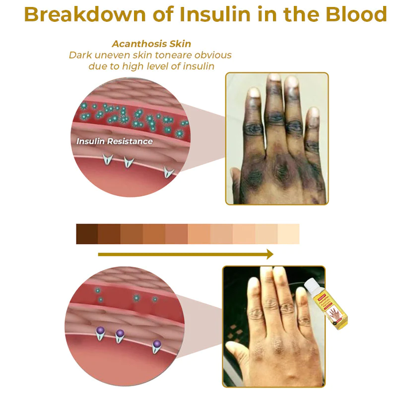 GFOUK™ PeelingPlus Acanthosis Nigricans Therapy Oil - Image 3